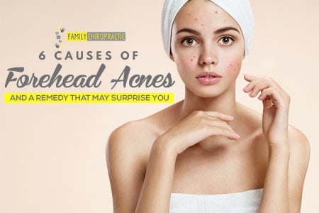 6 Causes Of Forehead Acnes And A Remedy That May Surprise You