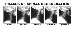 Spinal Degeneration Phases